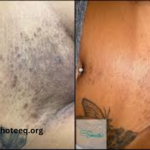 Full Brazilian Laser Hair Removal Before and After Photos (1)