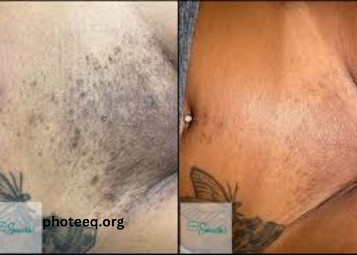 Full Brazilian Laser Hair Removal Before and After Photos (1)